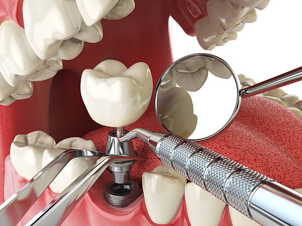 Best Lost Filling or Crown Replacement in Fort Belvoir, VA